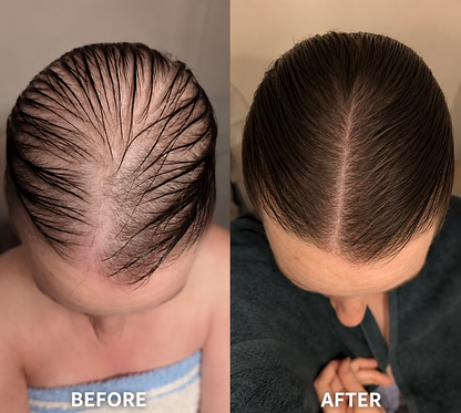 Minoxidil hair growth foam