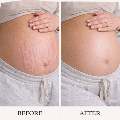 Stretch Mark Prevention Set